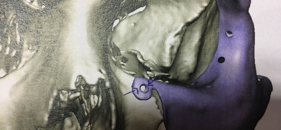 implant-1