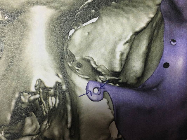 implant-1