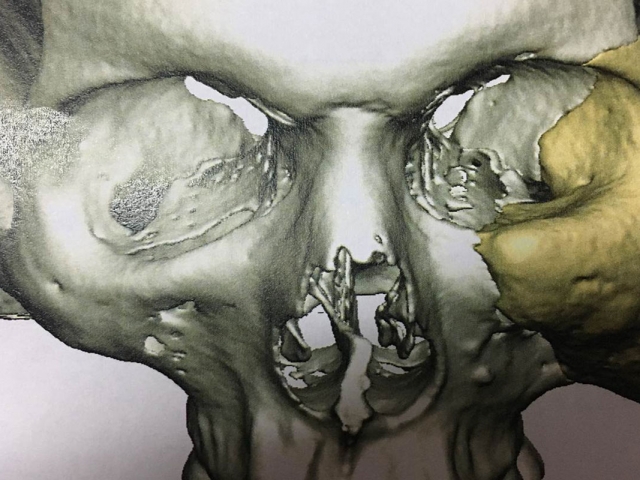 implant-10