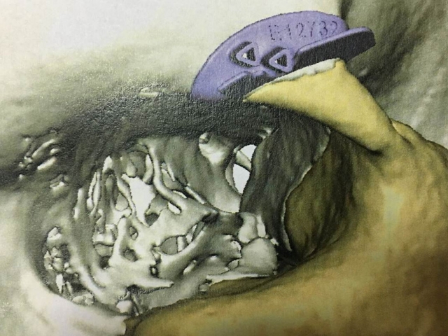 implant-6