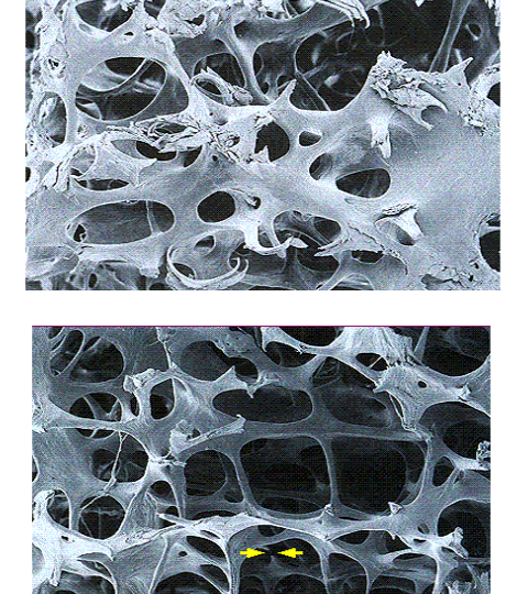 osteoporoza 1