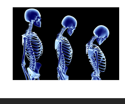 osteoporoza 2